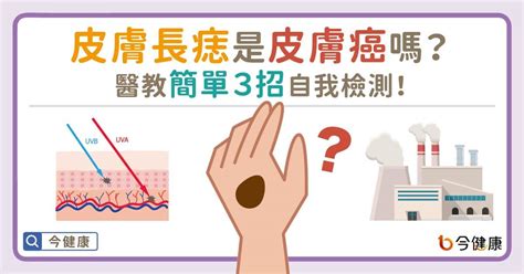 腳後跟突然長痣|皮膚長痣是皮膚癌嗎？常見症狀，簡單3招自我檢測｜ 